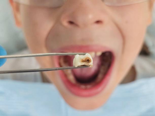 Best Emergency Dentist for Knocked-Out Tooth in Edmonds, WA